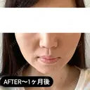 糸リフト / ヒアルロン酸注入（頬） EMMA CLINIC（エマクリニック） AFTER サムネイル用