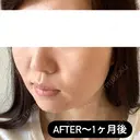 糸リフト / ヒアルロン酸注入（頬） EMMA CLINIC（エマクリニック） DAY 33 サムネイル用