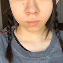 エレクトロポレーション / 毛穴洗浄（ハイドラフェイシャルなど） AURORA CLINIC（オーロラクリニック）新宿院 AFTER サムネイル用