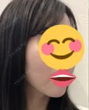 脂肪注入（輪郭） 湘南美容クリニック 新潟院 DAY 47 サムネイル用