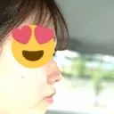 スレッドノーズ シンシアガーデンクリニック 太田院 AFTER サムネイル用