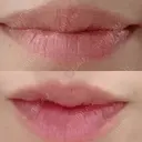 シワ取りボトックス 湘南美容クリニック 藤沢院 DAY 6 サムネイル用