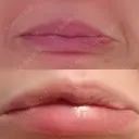 シワ取りボトックス 湘南美容クリニック 藤沢院 DAY 6 サムネイル用