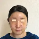 額を丸く / 脂肪注入（額） / 脂肪注入（輪郭） eクリニック 金沢本院 DAY 5 サムネイル用