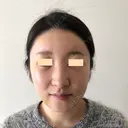 額を丸く / 脂肪注入（額） / 脂肪注入（輪郭） eクリニック 金沢本院 DAY 14 サムネイル用