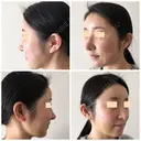 額を丸く / 脂肪注入（額） / 脂肪注入（輪郭） eクリニック 金沢本院 DAY 14 サムネイル用