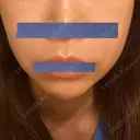 糸リフト / 脂肪溶解注射（顔） 東京ロイヤルクリニック AFTER サムネイル用