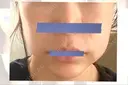 糸リフト / 脂肪溶解注射（顔） 東京ロイヤルクリニック DAY 3 サムネイル用