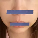 糸リフト / 脂肪溶解注射（顔） 東京ロイヤルクリニック DAY 6 サムネイル用