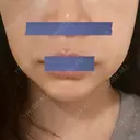 糸リフト / 脂肪溶解注射（顔） 東京ロイヤルクリニック DAY 16 サムネイル用
