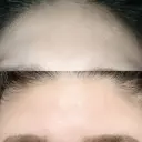 額を丸く / シワ取りボトックス / その他（肌） / その他（輪郭） 湘南美容クリニック 藤沢院 DAY 7 サムネイル用