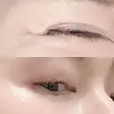 シワ取りボトックス 湘南美容クリニック 藤沢院 DAY 7 サムネイル用