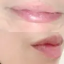 シワ取りボトックス 湘南美容クリニック 藤沢院 DAY 7 サムネイル用