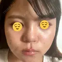 隆鼻術 湘南美容クリニック 姫路院 DAY 7 サムネイル用