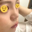 隆鼻術 湘南美容クリニック 姫路院 DAY 11 サムネイル用