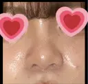 隆鼻術 湘南美容クリニック 姫路院 AFTER サムネイル用