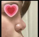 隆鼻術 湘南美容クリニック 姫路院 DAY 256 サムネイル用