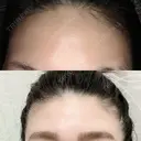 額を丸く / シワ取りボトックス / その他（肌） / その他（輪郭） 湘南美容クリニック 藤沢院 DAY 9 サムネイル用