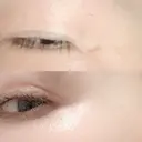 シワ取りボトックス 湘南美容クリニック 藤沢院 DAY 9 サムネイル用