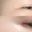 シワ取りボトックス 湘南美容クリニック 藤沢院 DAY 9 サムネイル用