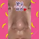 鼻尖形成（切開） / 小鼻縮小（切開） / 軟骨移植 / 鼻孔縁挙上 / 鼻尖縮小 ヴェリテクリニック 大阪院 DAY 28 サムネイル用