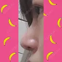 鼻尖形成（切開） / 小鼻縮小（切開） / 軟骨移植 / 鼻孔縁挙上 / 鼻尖縮小 ヴェリテクリニック 大阪院 DAY 28 サムネイル用