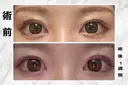 蒙古ひだ形成 R.O.clinic DAY 12 サムネイル用
