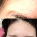 額を丸く / シワ取りボトックス / その他（肌） / その他（輪郭） 湘南美容クリニック 藤沢院 DAY 10 サムネイル用