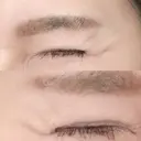 シワ取りボトックス 湘南美容クリニック 藤沢院 DAY 12 サムネイル用