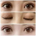 二重切開 / 上まぶたたるみ取り 城本クリニック 姫路院 DAY 41 サムネイル用