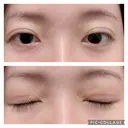 二重切開 松下皮フ形成外科 DAY 26 サムネイル用
