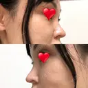 隆鼻術 / 鼻尖形成（切開） / 鼻中隔延長（切開） / 軟骨移植 / プロテーゼ除去 / 鼻修正 THE ROPPONGI CLINIC（ザ 六本木クリニック） DAY 78 サムネイル用