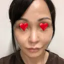 隆鼻術 / 鼻尖形成（切開） / 鼻中隔延長（切開） / 軟骨移植 / プロテーゼ除去 / 鼻修正 THE ROPPONGI CLINIC（ザ 六本木クリニック） DAY 78 サムネイル用