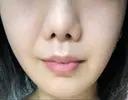 糸リフト EMMA CLINIC（エマクリニック） AFTER サムネイル用