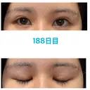 上まぶたの脂肪取り / 眉下切開 JUN CLINIC DAY 188 サムネイル用