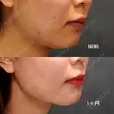 脂肪吸引（顔） ヴェルトラクリニック 大阪院 DAY 48 サムネイル用