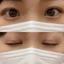 二重切開 EMMA CLINIC（エマクリニック） AFTER サムネイル用