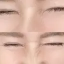 シワ取りボトックス 湘南美容クリニック 藤沢院 DAY 12 サムネイル用