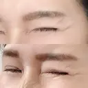 シワ取りボトックス 湘南美容クリニック 藤沢院 DAY 12 サムネイル用