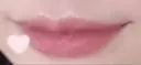 ヒアルロン酸注入（唇） / ボトックス（口角） フィラークリニック 大阪心斎橋院 AFTER サムネイル用
