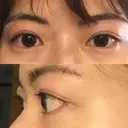 二重埋没 / 上まぶたの脂肪取り / 眉下切開 湘南美容クリニック 高田馬場院 AFTER サムネイル用