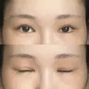 二重切開 / 目頭切開 / 眼瞼下垂（切開） / 上まぶたの脂肪取り 銀座マイアミ美容外科 DAY 121 サムネイル用
