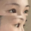 二重切開 / 目頭切開 / 眼瞼下垂（切開） / 上まぶたの脂肪取り 銀座マイアミ美容外科 DAY 121 サムネイル用