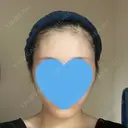 糸リフト / 脂肪吸引（顔） 銀座マイアミ美容外科 DAY 120 サムネイル用