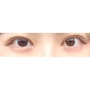 二重切開 / 目頭切開 東京イセアクリニック DAY 157 サムネイル用