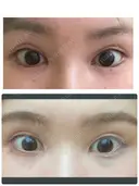 目尻切開 / タレ目形成・グラマラスライン（切開） ビスポーククリニック 福岡院 AFTER サムネイル用