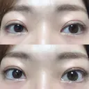二重切開 松下皮フ形成外科 DAY 77 サムネイル用
