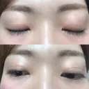 二重切開 松下皮フ形成外科 DAY 77 サムネイル用