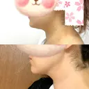 糸リフト / 脂肪吸引（顔） / 脂肪吸引（脚） / 脂肪吸引（お尻） 湘南美容クリニック 札幌院 DAY 17 サムネイル用