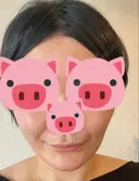 脂肪吸引（顔） / 切開リフト / ヒアルロン酸注入（ほうれい線） 東京エビスクリニック DAY 152 サムネイル用